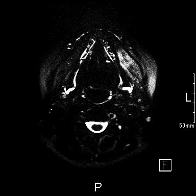 唾液腺MRI